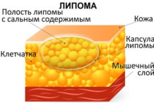 Липома – что это такое и как лечить? Симптомы и лечение