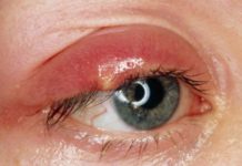 Чирей на глазу у ребенка, взрослого: причина появления, чем и как лечить в домашних условиях |