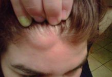 Липома на голове: удаление, причины, лечение