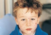 Мелкая сыпь на теле у ребенка — 11 причин с фото