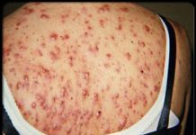 Почему появляются прыщи на спине: причины и лечение