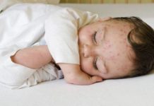 Чем может оказаться сыпь на голове у ребенка — Детское здоровье