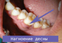 Гнойник на десне у ребенка – что делать, как лечить нарыв