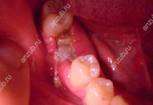 Гноится десна после удаления зуба — Анатомия зубов