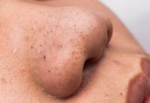 Маска от черных точек: 12 самых популярных и эффективных средств