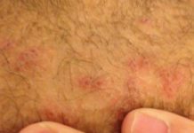 Прыщи на половых губах: почему возникают белые точки, воспаление малой и большой половых желез, красные прыщики во влагалище? |