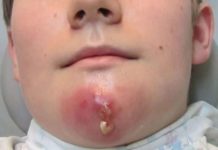 Фурункул на лице: почему появляются, как лечить в домашних условиях без шрамов |