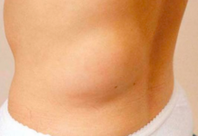 Жировик- не страшно, но попробуем от него избавиться — ЭкоБабуля! Советы для вас, которыми стоит поделиться! медиаплатформа МирТесен