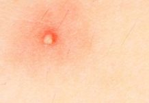 Диабет и фурункулы: лечение, связь заболеваний