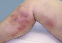 Тромбофлебит нижних конечностей: симптомы, фото, лечение