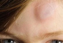 8 методов избавиться от липомы (жировика) без операции, дома