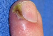 Как быстро вылечить нарыв на пальце возле ногтя или панариций