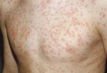 Папулезная сыпь | Морфологические элементы