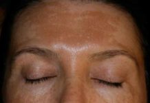 Высыпания на коже при болезни печени: различные виды высыпаний