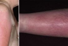 Как выглядят высыпания на коже при заболеваниях кишечника и ЖКТ