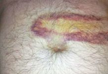 Пятна на коже при заболеваниях поджелудочной железы, причины кожных высыпаний при болезнях |