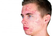 Как избавится от подростковых прыщей и черных точек на лице очень быстро?