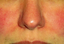 Покраснение и шелушение кожи на лице — фото, причины, лечение