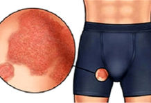 Покраснения в паху у мужчин — фото, причины, лечение