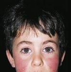 Инфекционная сыпь