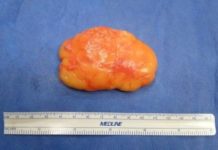 После удаления жировика уплотнения остается какое то время