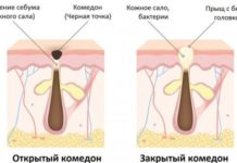 От чего появляются черные точки на лице: причины и меры профилактики