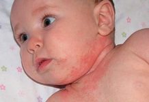 Как лечить потницу у новорожденного в домашних условиях и как выглядит?