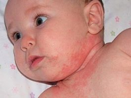 Как лечить потницу у новорожденного в домашних условиях и как выглядит?