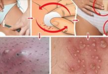 Появление прыщей в интимной зоне у женщин — способы лечения и профилактики