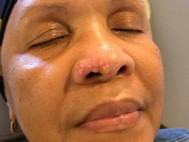 Простуда (герпес) на носу, ее причины и лечение