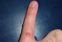 Прыщи на пальцах рук: фото, причины и как избавится