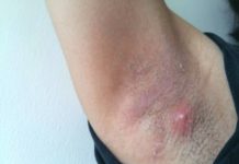 Прыщи под мышками: все причины с фото и как избавиться
