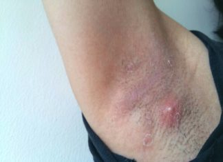 Прыщи под мышками: все причины с фото и как избавиться