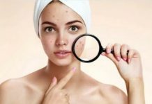 Почему перед месячными прыщи на лице и подбородке и как бороться?