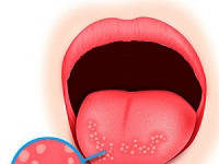 Прыщик на языке белые и красные — фото, причины, болезни