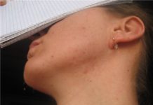 Прыщи на шее у мужчин и женщин: фурункулы на коже