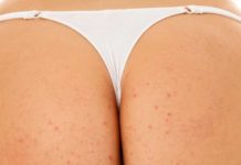 Прыщи на попе у женщин и мужчин: знакомство с причинами