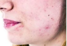 Прыщи от печени: симптомы, причины