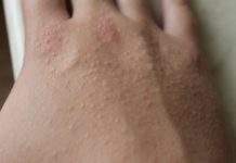 Чешется кожа и появляются пупырышки