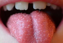 Красные и белые пупырышки и прыщики на языке у ребенка: причины появления, малиновый язык с пупырышками