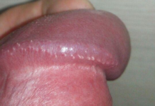 Какие пупырышки на головке пениса нельзя игнорировать? | Уролог онлайн