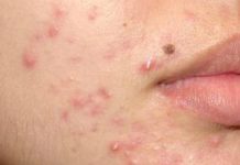 Пустула: причины, симптомы, лечение