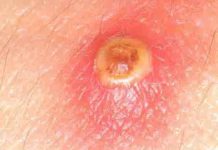 Что такое пустула, причины появления, фото и лечение