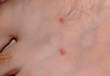 Пузырьки на стопах: фото, возможные болезни, лечение