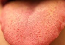 На языке язва, вскочила белая болячка, мозоль: как лечить и избавиться навсегда? |