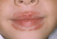 Раздражение вокруг рта у ребенка и взрослого: причины, лечение и профилактика