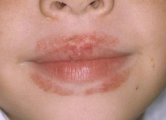 Раздражение вокруг рта у ребенка и взрослого: причины, лечение и профилактика