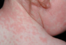 Герпес 6 типа у детей диагностика и лечение болезни