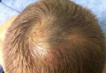 Как распознать и избавиться от гнойников в волосах на голове |