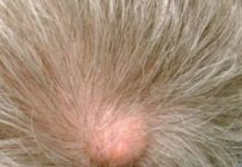 Жировик на голове болит на голове: к какому врачу обратиться, лечение липомы |